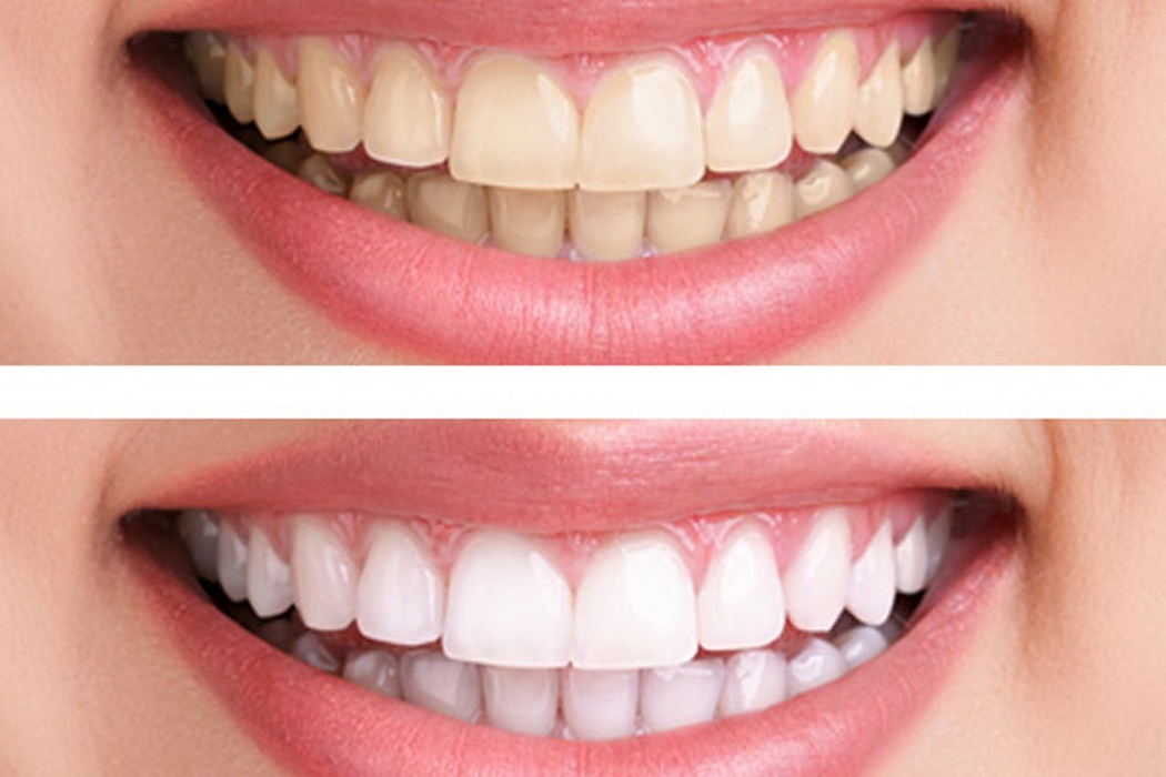 Dental Care Advice
